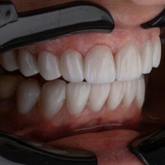 dental implants