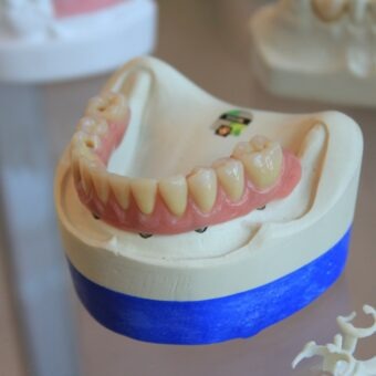 Dental Implants vs Dentures