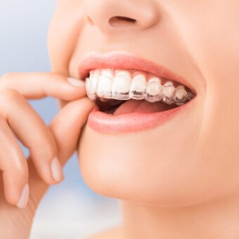 Invisalign treatment at South Shore Dental